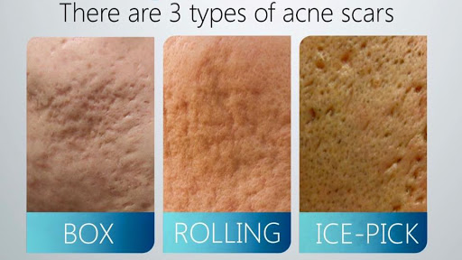 Các loại sẹo rỗ nhẹ thường gặp trên da mặt