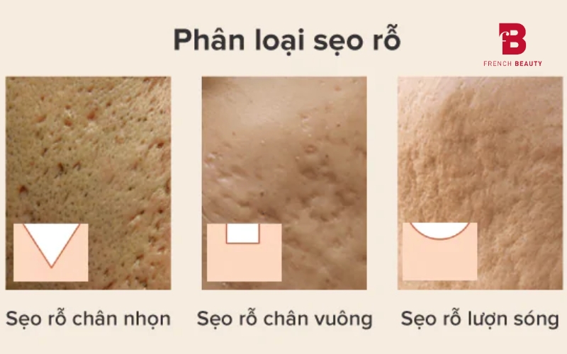 Các loại sẹo rỗ phổ biến