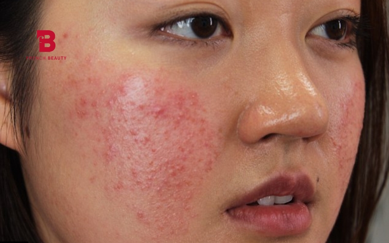 Dấu hiệu phổ biến khi da bị kích ứng bởi mỹ phẩm