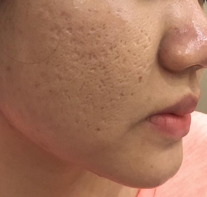 10 Cách chăm sóc và tái tạo da mặt bị rỗ cải thiện rõ rệt